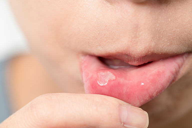 Ko napadejo afte Afte v ustih